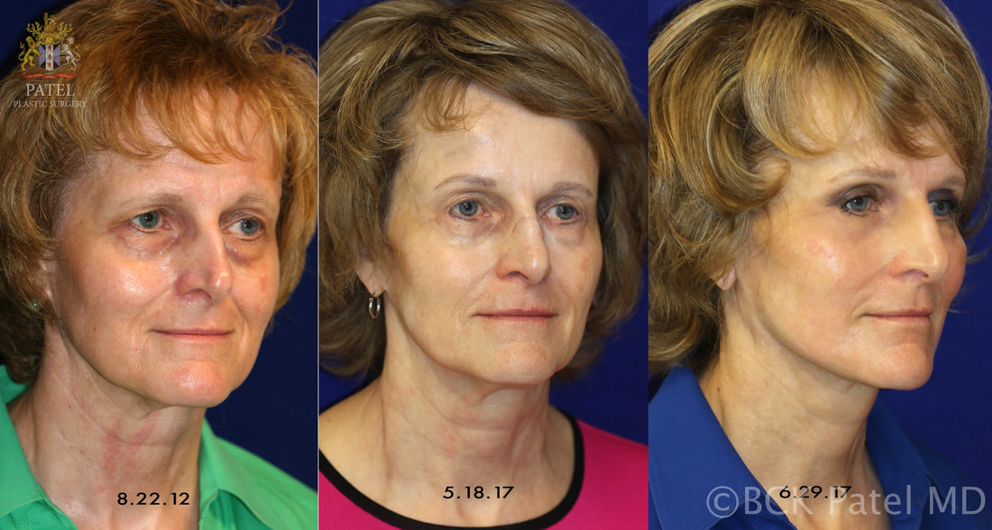 Rejuvenation of a female in her 50's with brow lifts, upper and lower blepharoplasty and facelift and necklift by Dr. BCK Patel MD, FRCS of Patel Plastic Surgery Salt Lake City and St. George, Utah