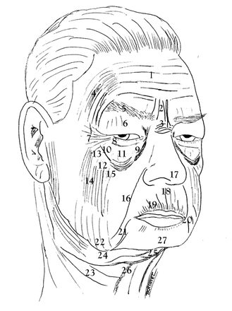 Illustration of aging as it affects the different parts of the face showing jowls, loss of jawline, facial lines, neck laxity by Dr. BCK Patel MD, FRCS