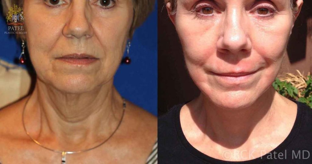 Beautiful result of a lower facelift and necklift by Dr BCK Patel MD, FRCS turning a square jawline to an elegant oval jawline bringing back a youthful face PatelPlasticSurgery.com of Salt Lake City and St. George, Utah