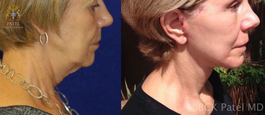 Beautiful result of a lower facelift and necklift by Dr BCK Patel MD, FRCS turning a square jawline to an elegant oval jawline bringing back a youthful face PatelPlasticSurgery.com of Salt Lake City and St. George, Utah