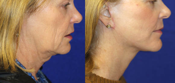 State of the Art Plastic Surgery results of a lower facelift and necklift eradicating jowls and loose neck bands and folds by Dr. BCK Patel MD, FRCS of patelplasticsurgery.com in Salt Lake City and St. George, Utah