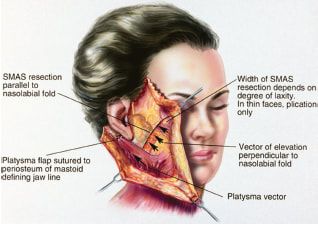 Surgical technique of the deep plane facelift by Dr. BCK Patel MD, FRCS of Patel Plastic Surgey Salt Lake City and St. George, Utah