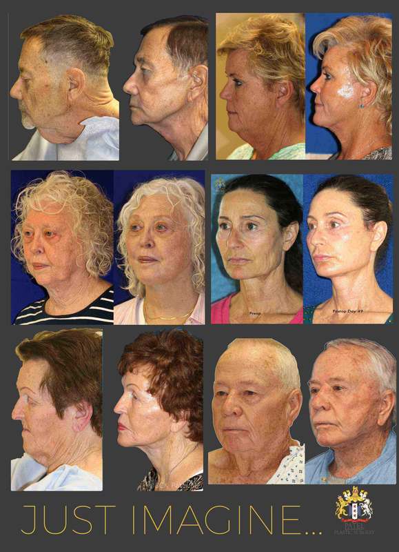 Examples of facelift and necklift in men and women of different ages showing the improvement in the lower face, the mouth, the lips, eradication of jowls, improvement of the jawline, the neck and chin by Dr. BCK Patel MD, FRCS of patelplasticsurgery.com in Salt Lake City and St. George, Utah