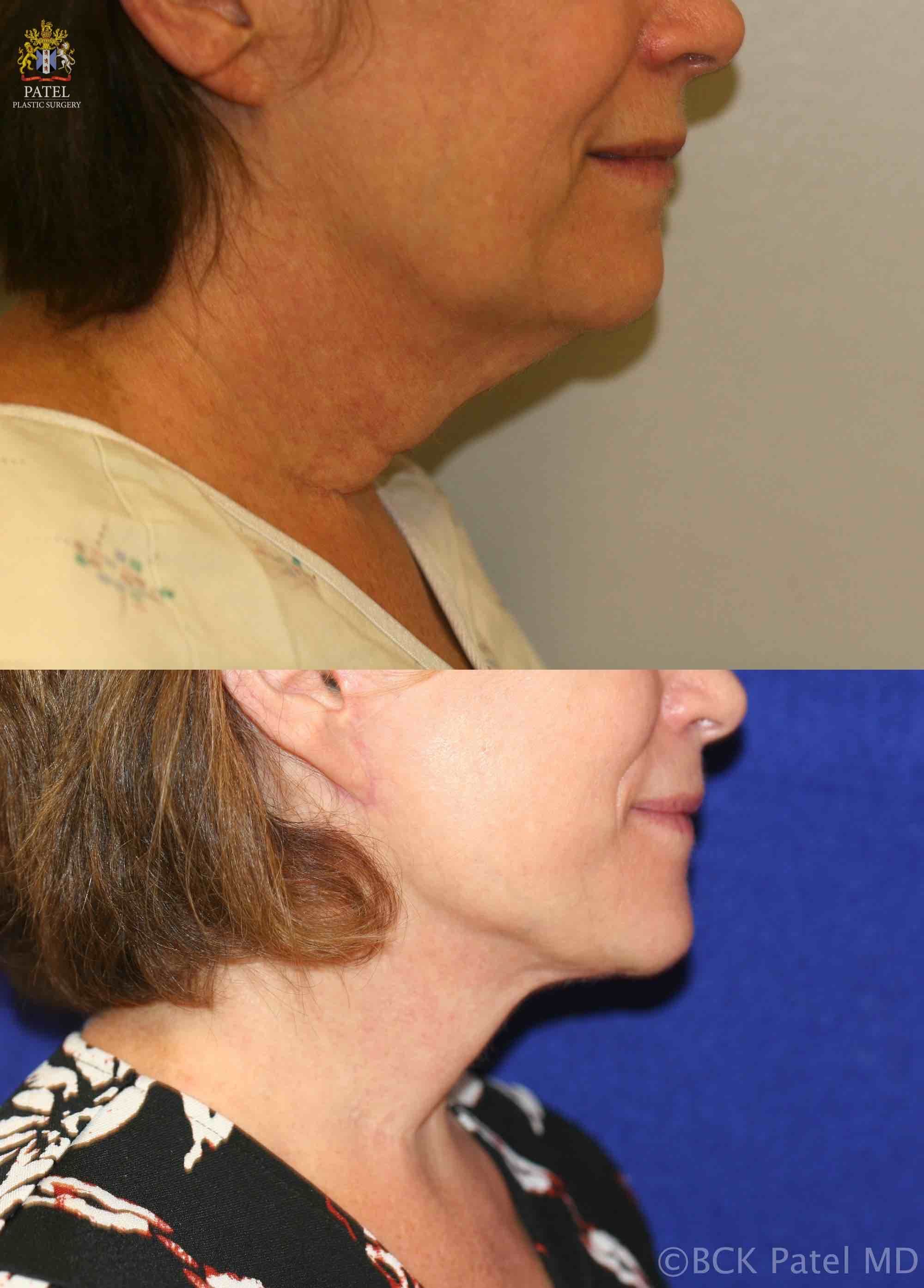Facelift and necklift giving a beautiful result; Surgery by Dr. BCK Patel MD, FRCS, Salt Lake City, Patel Plastic Surgery