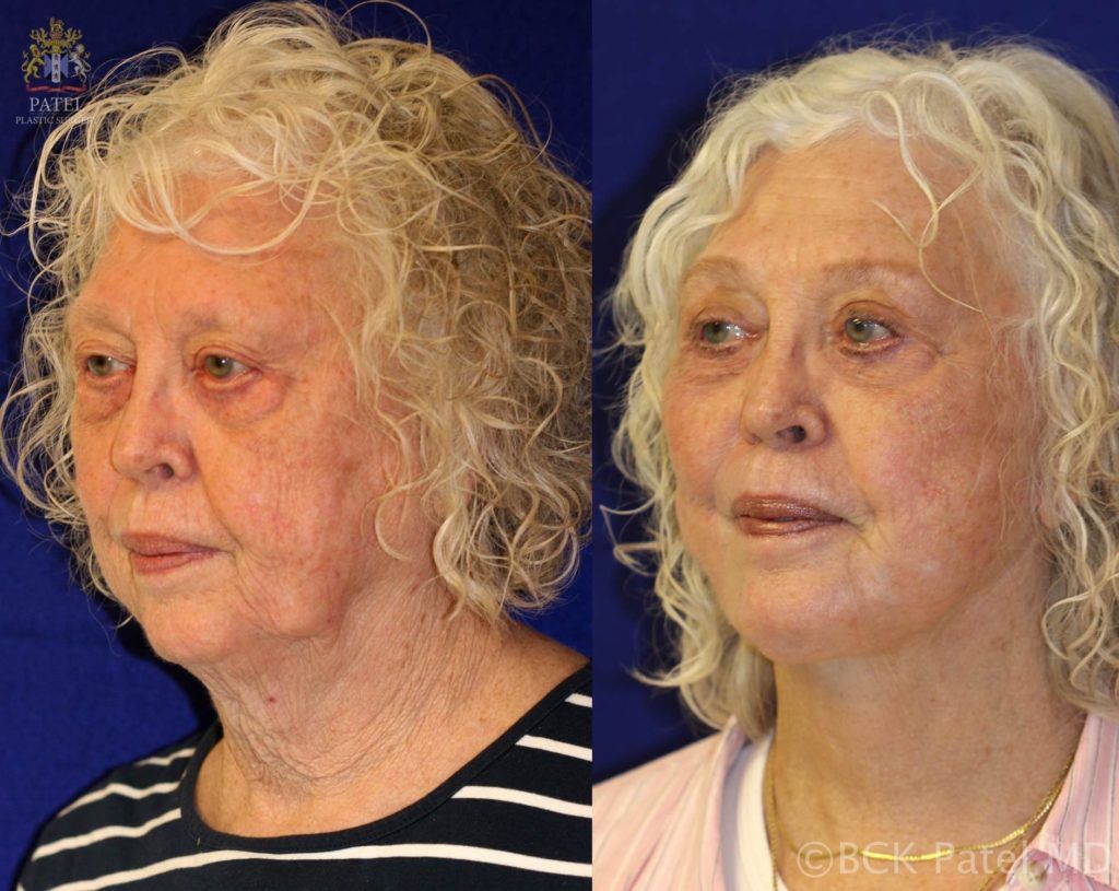 Facelift and necklift giving a beautiful result; Surgery by Dr. BCK Patel MD, FRCS, Salt Lake City, patelplasticsurgery.com of St. George and Salt Lake City Utah