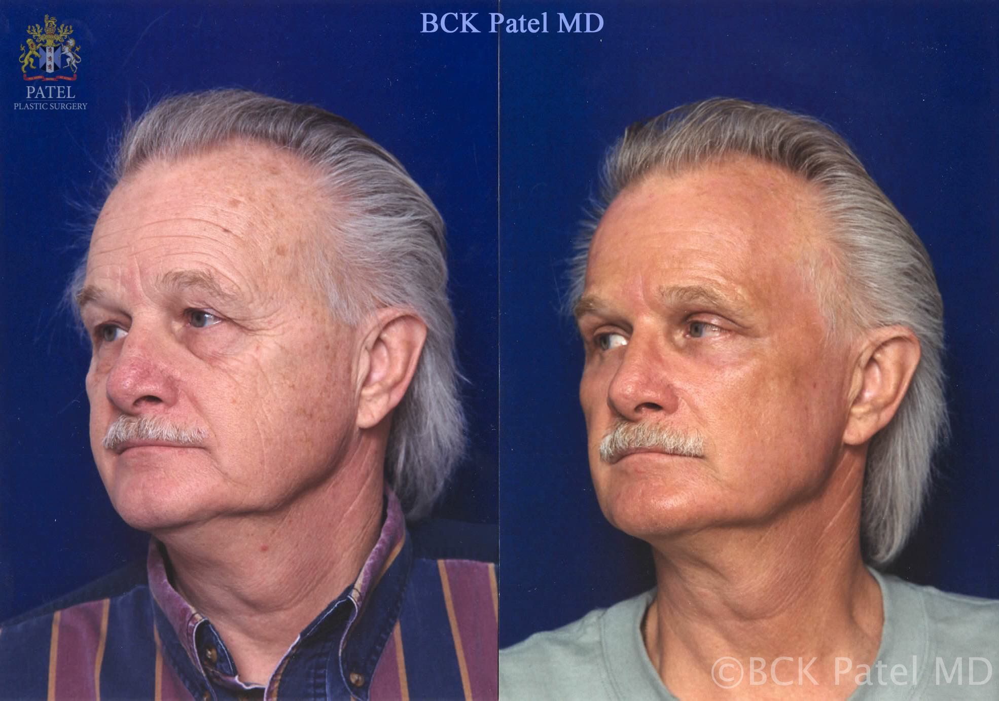 Hammock Lift in a male showing comprehensive improvement of the face by Dr. BCK Patel MD, FRCS of patelplasticsurgery.com of Salt Lake City and St. George Utah