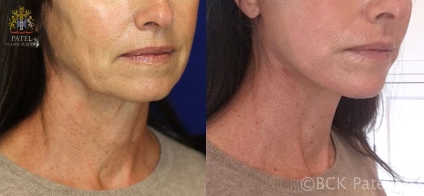 Facelift and necklift giving a beautiful result; Surgery by Dr. BCK Patel MD, FRCS, Salt Lake City, Patel Plastic Surgery