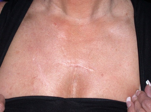 Before and after laser skin resurfacing neck and chest IPL by Dr. BCK Patel MD, FRCS