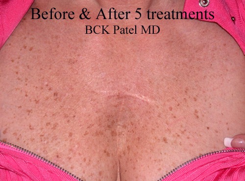 Before and after laser skin resurfacing neck and chest IPL by Dr. BCK Patel MD, FRCS