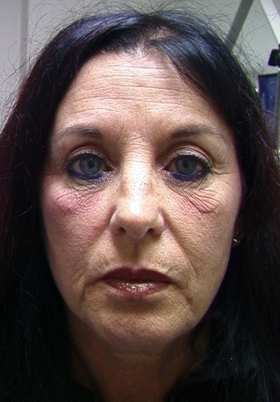 The amazing Hammock Lift: results with the use of the Hammock Lift, nanofatgrafts, fractionated CO2 laser Dr. BCK Patel MD, FRCS of patelplasticsurgery.com of Salt Lake City and St. George Utah