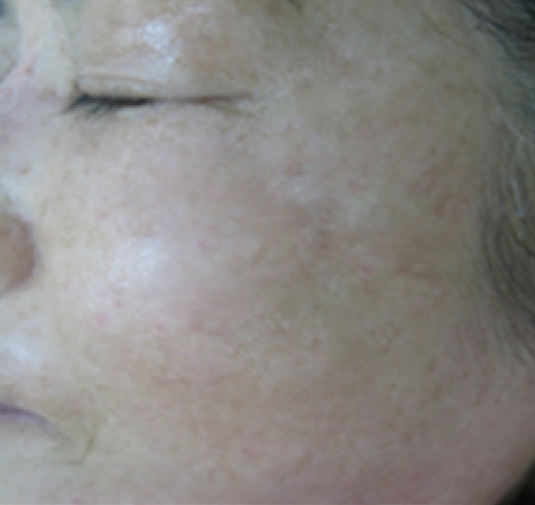 Melasma removal with advanced lasers by Dr. BCK Patel MD, FRCS of patelplasticsurgery.com of Salt Lake City and St. George, Utah