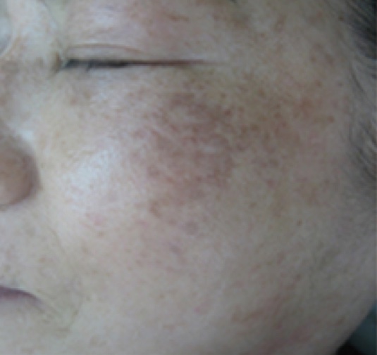 Melasma removal with advanced lasers by Dr. BCK Patel MD, FRCS of patelplasticsurgery.com of Salt Lake City and St. George, Utah