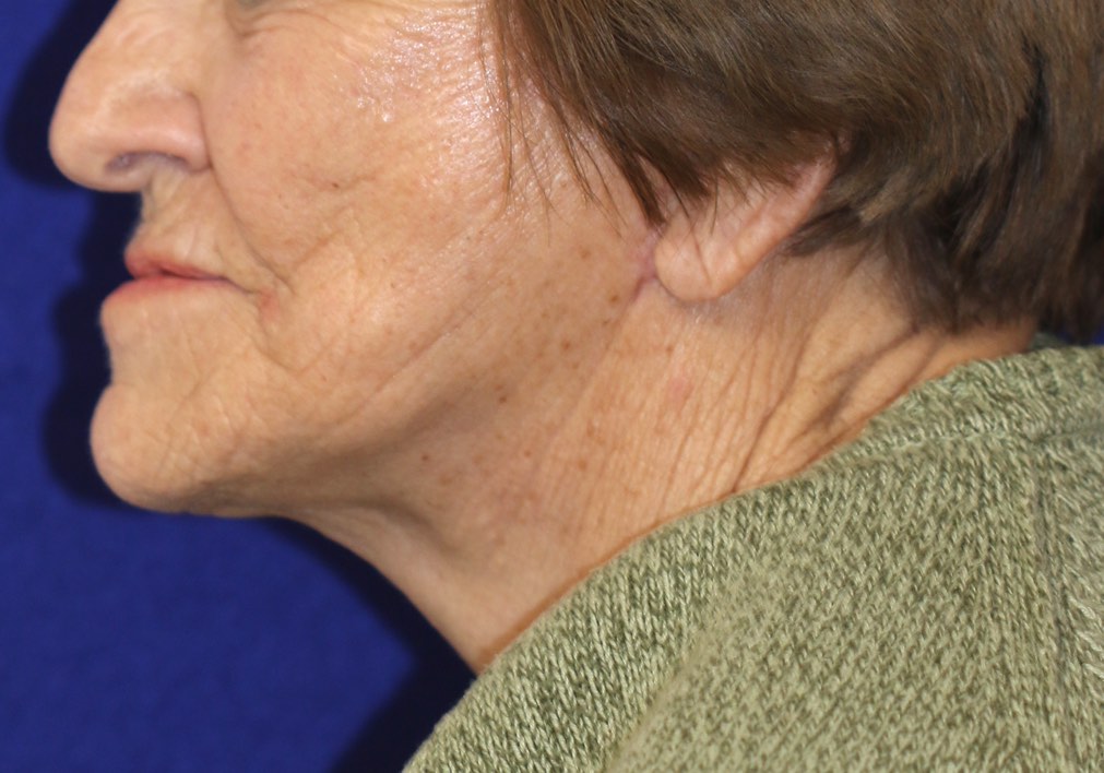 Nice improvement in the lower face, jawline and neck after a properly performed lower facelift and necklift by Dr. BCK Patel MD, FRCS of Salt Lake City