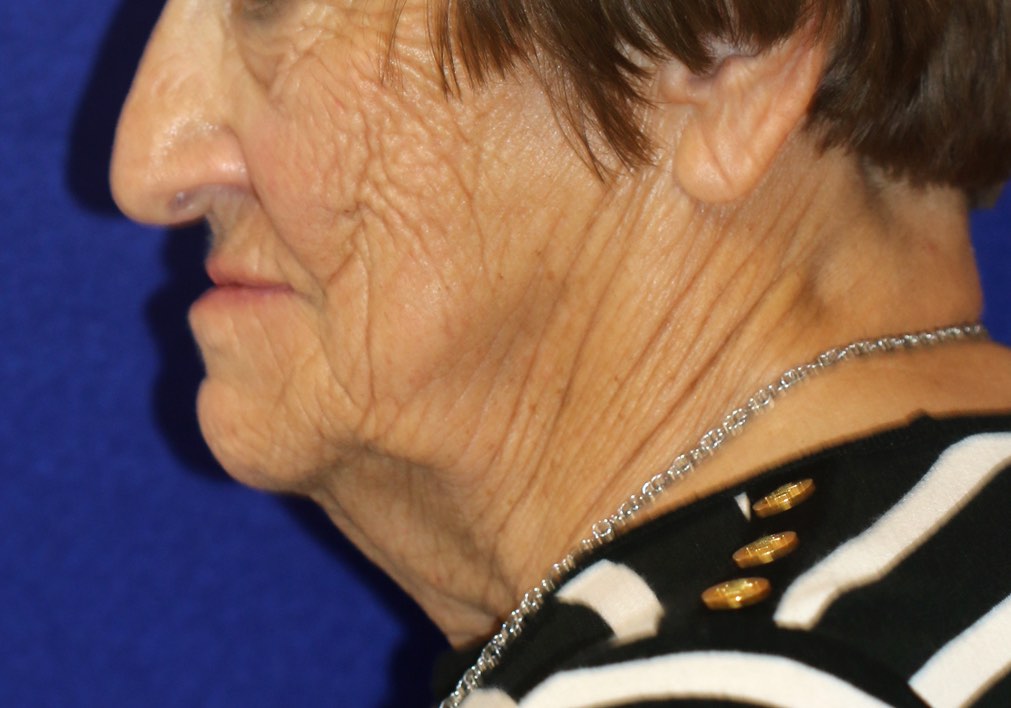 Aging of the lower face, jawline and neck in an older lady