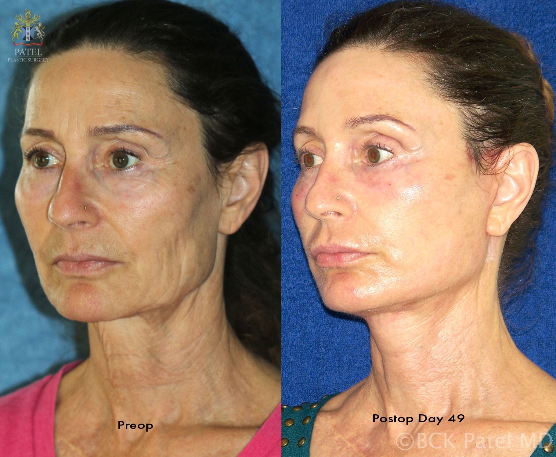 Facelift and necklift giving a beautiful result; Surgery by Dr. BCK Patel MD, FRCS, Salt Lake City, Patel Plastic Surgery Results at 49 days after a lower face and necklift and the use of the fractionated CO2 laser