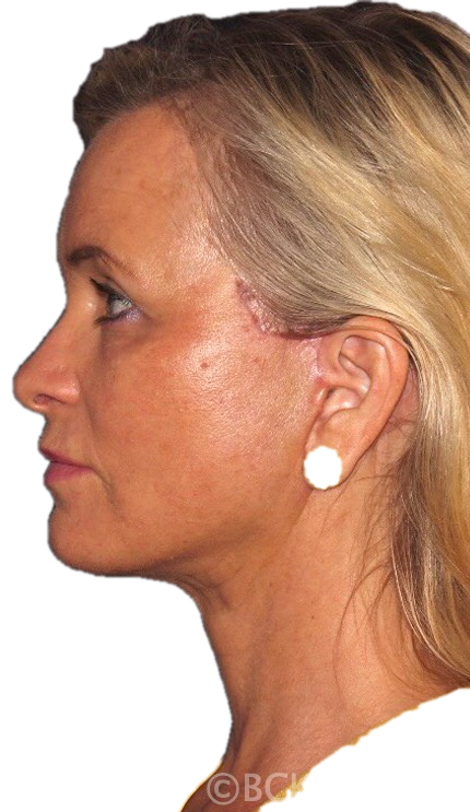 Improvement shown in the skin, the forehead, lids, lower face and neck and jawline after facelift and neck lift surgery designed and performed by Dr. BCK Patel MD, FRCS of Salt Lake City and St. George