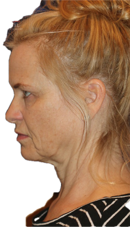 Aging changes in a female in her 50s