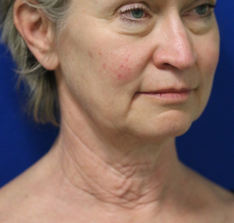 Facelift and necklift together with the use of nanofatgrafts and the fractionated co2 laser to give a comprehensive improvement to the cheeks, lower face, jowls, jawline and neck in a female. By Dr. BCK Patel MD, FRCS of patelplasticsurgery.com of Salt Lake City and St. George, Utah