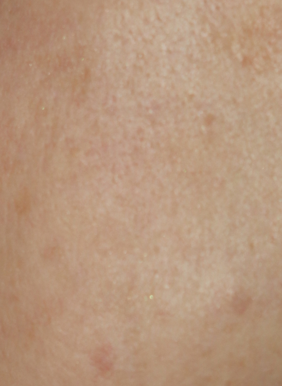 Carbon Peel: Reduction of pores on the face with the laser