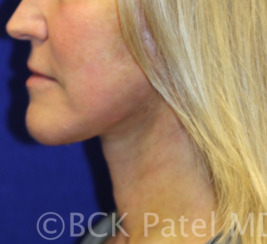 Midi facelift: appearance after surgery