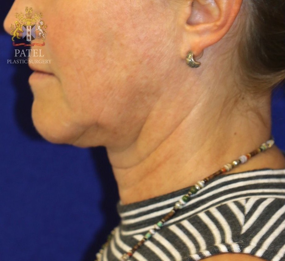 Aging of the lower face, jawline and neck in a female