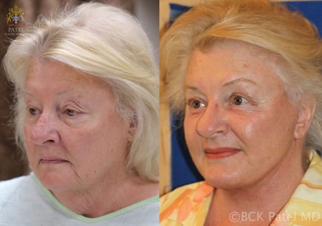 Facelift and necklift giving a beautiful result; Surgery by Dr. BCK Patel MD, FRCS, Salt Lake City and St. George, Patel Plastic Surgery