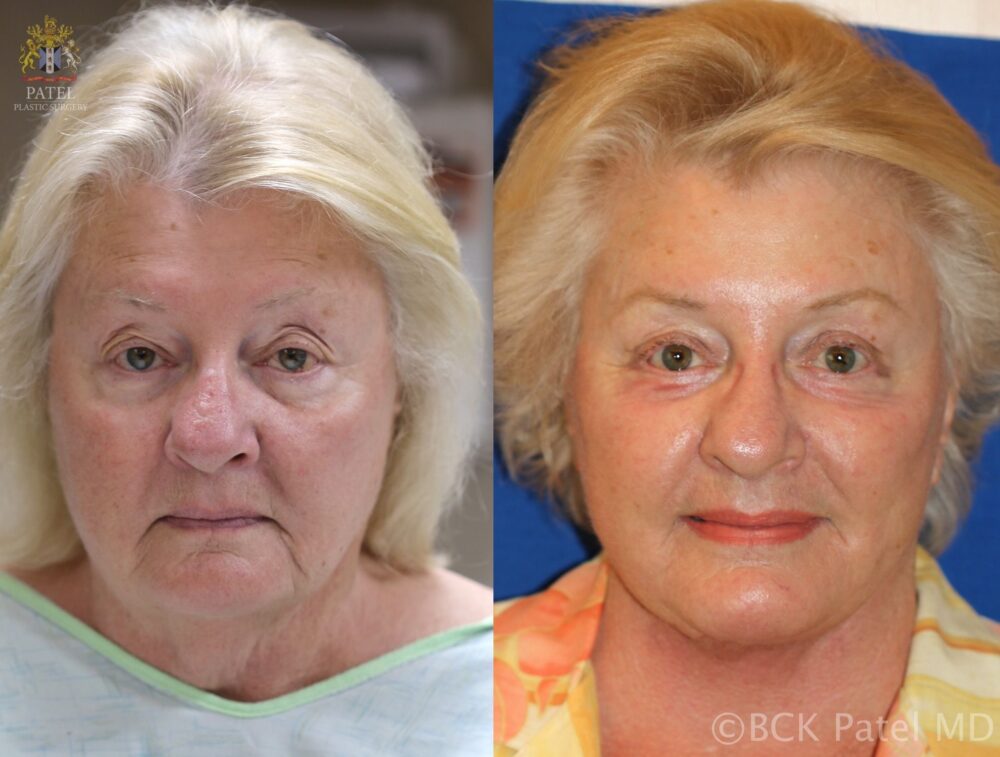 Facelift and necklift giving a beautiful result; Surgery by Dr. BCK Patel MD, FRCS, Salt Lake City and St. George, Patel Plastic Surgery