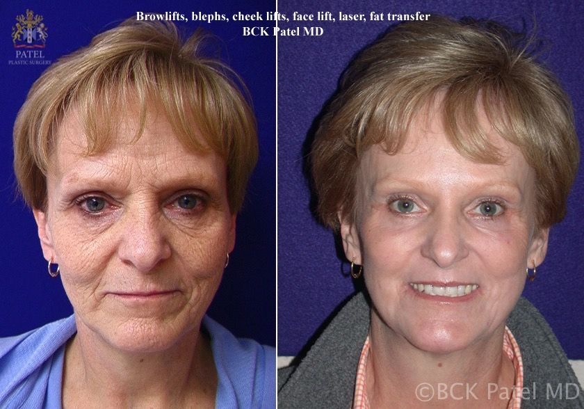 Hammock Lift by Dr. BCK Patel MD, FRCS of patelplasticsurgery.com of Salt Lake City and St. George Utah also showing the amazing improvement in the skin with the use of nanofatgrafts and the fractionated CO2 laser to the face. Patient had a forehead lift, browlift, upper and lower blepharoplasty and cheek lifts with fatgrafts and laser and perioral rejuvenation: the whole Hammock Lift experience. See the amazing results