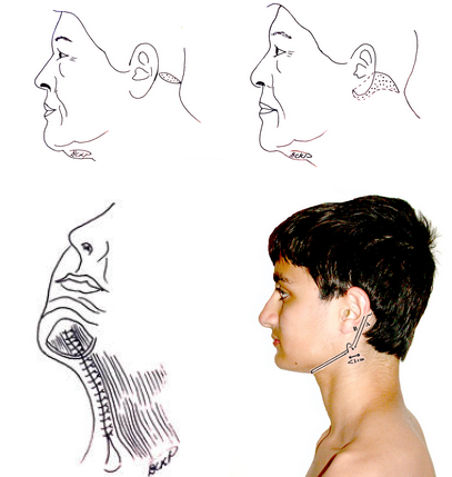 concave vs convex face