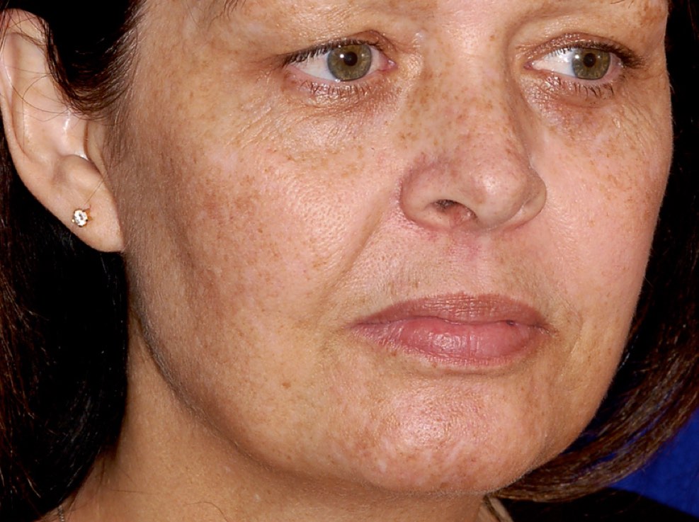 The power of lasers. Using advanced lasers of different wavelengths allows improvement in redness, brown spots, pores, fine lines and even gives some skin tightening. By Dr. BCK Patel MD, FRCS of patelplasticsurgery.com of Salt Lake City and St. George, Utah