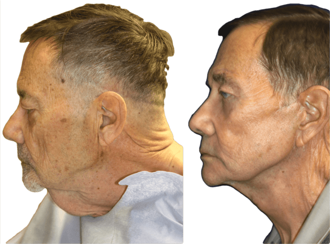 Facelift and necklift in a male giving a beautiful result; Surgery by Dr. BCK Patel MD, FRCS, Salt Lake City, Patel Plastic Surgery