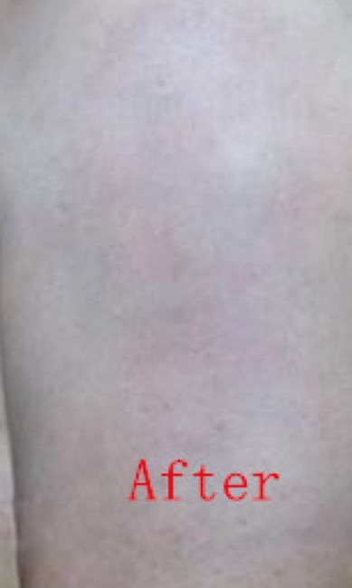 Tatto removal with advanced lasers by Dr. BCK Patel MD, FRCS of patelplasticsurgery.com of Salt Lake City and St. George, Utah
