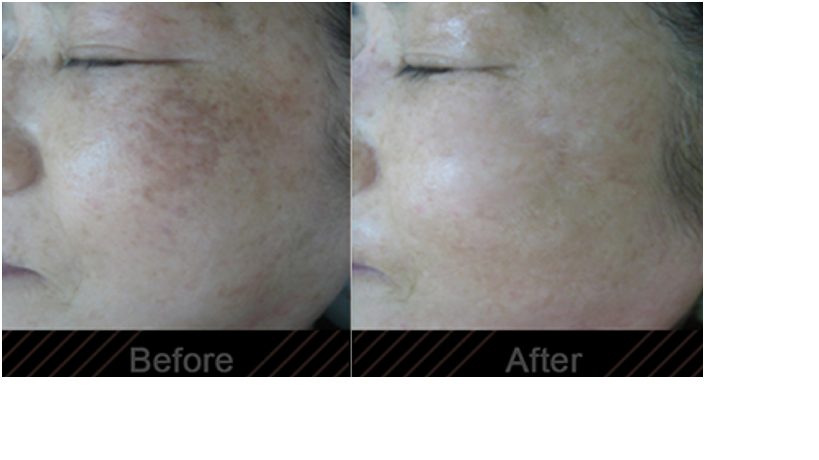 Melasma before and after in an Asian face by Dr. BCK Patel MD FRCS using Aerolase Laser