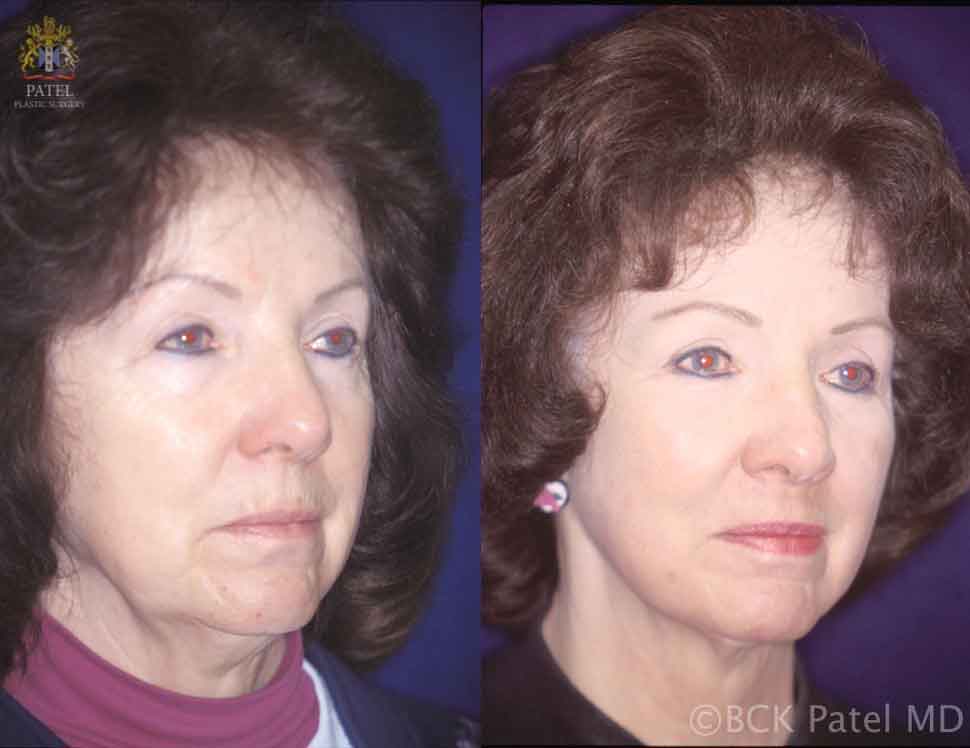 Hammock Lift results in a femaleshowing amazing improvement of the upper two-thirds of the face and the skin using minimally invasive technique by Dr. BCK Patel MD, FRCS of patelplasticsurgery.com of Salt Lake City and St. George Utah