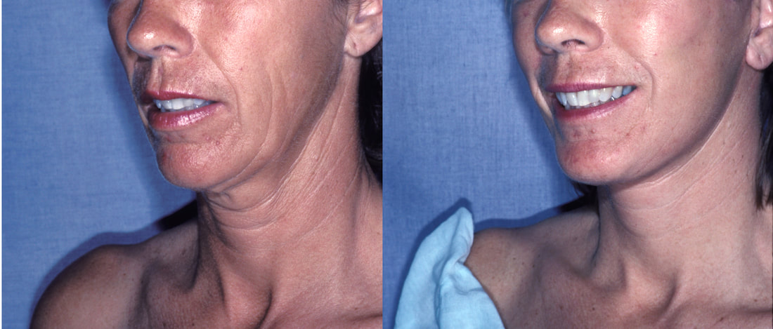 Facelift and necklift giving a beautiful result; Surgery by Dr. BCK Patel MD, FRCS, Salt Lake City, Patel Plastic Surgery