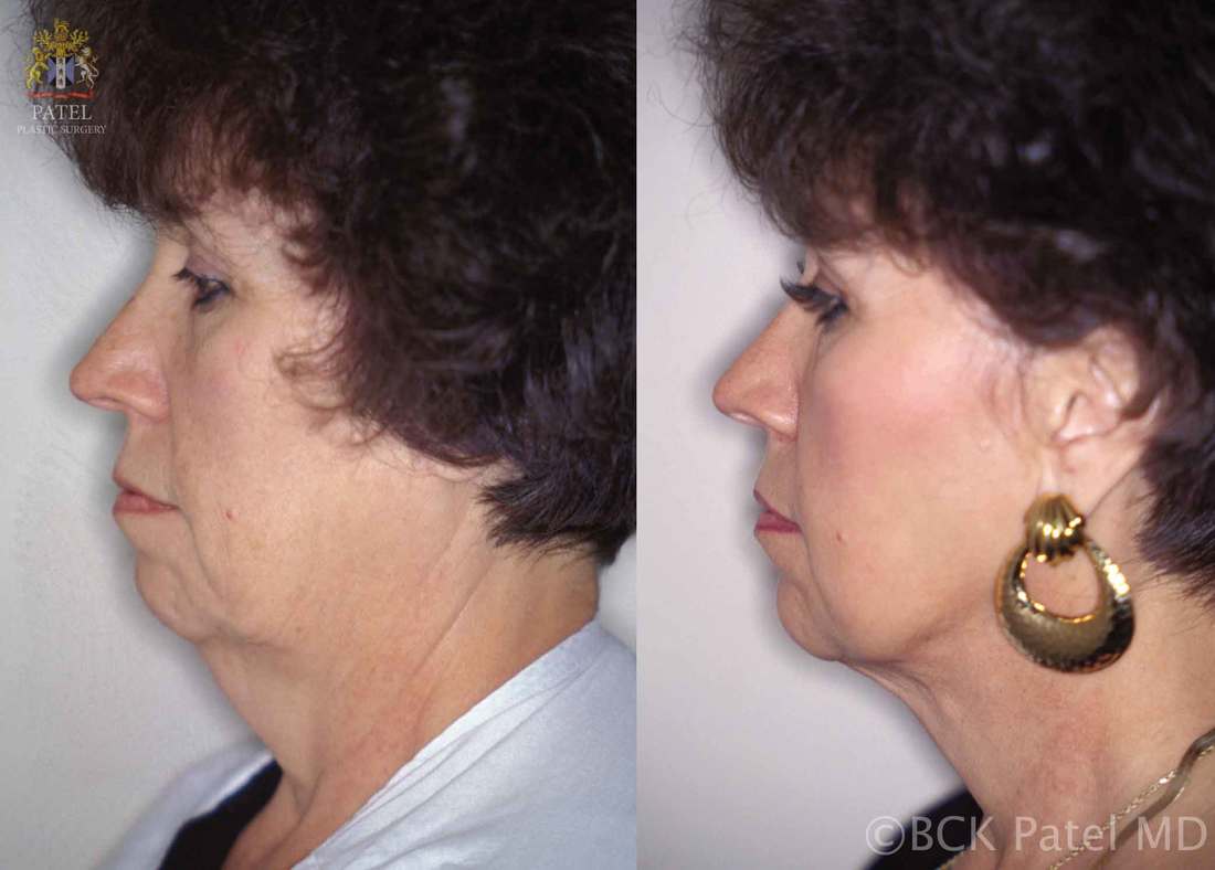Hammock Lift by Dr. BCK Patel MD, FRCS of patelplasticsurgery.com of Salt Lake City and St. George Utah Results of a Hammock Lift shown in a female with amazing results