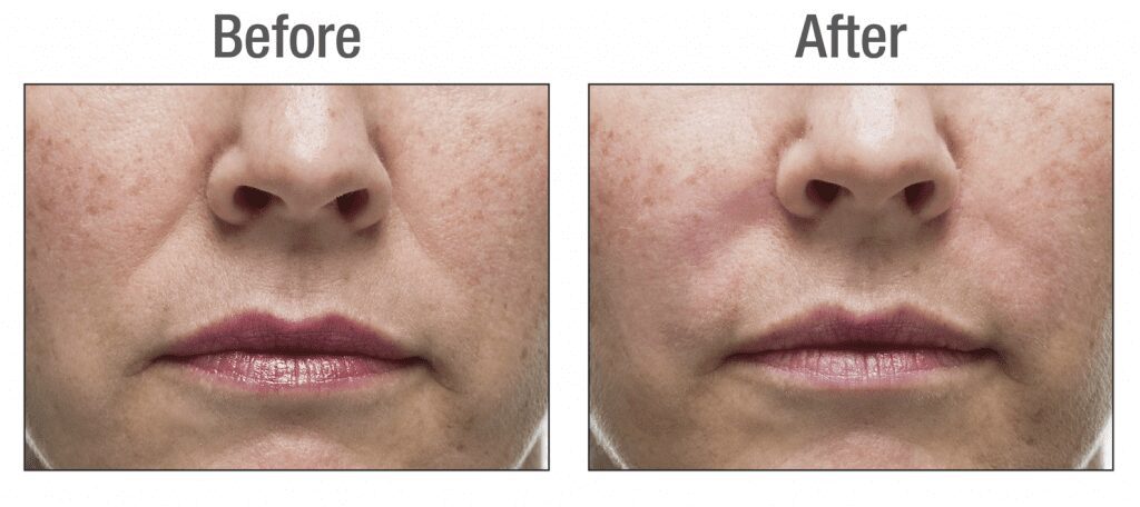 Radiesse filler for nasolabial folds in a female by Dr. BCK Patel MD, FRCS