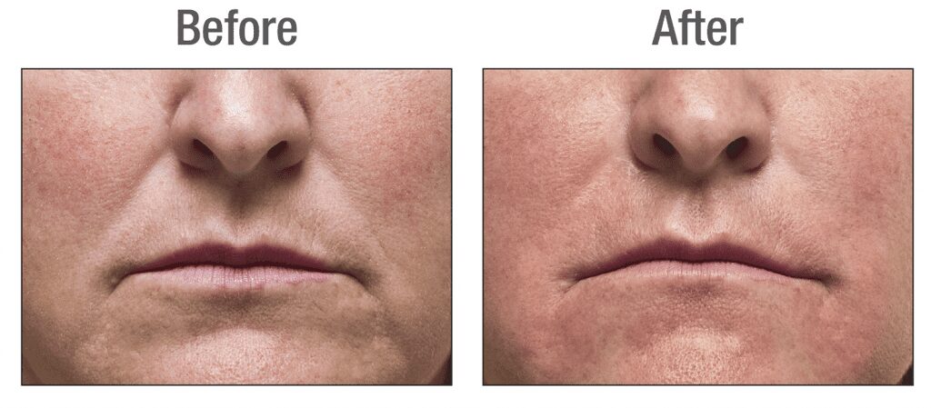 Radiesse filler for nasolabial folds in a male by Dr. BCK Patel MD, FRCS