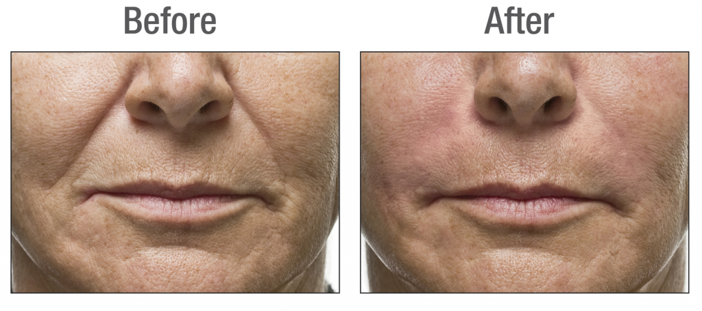 Radiesse filler for nasolabial folds in a male by Dr. BCK Patel MD, FRCS
