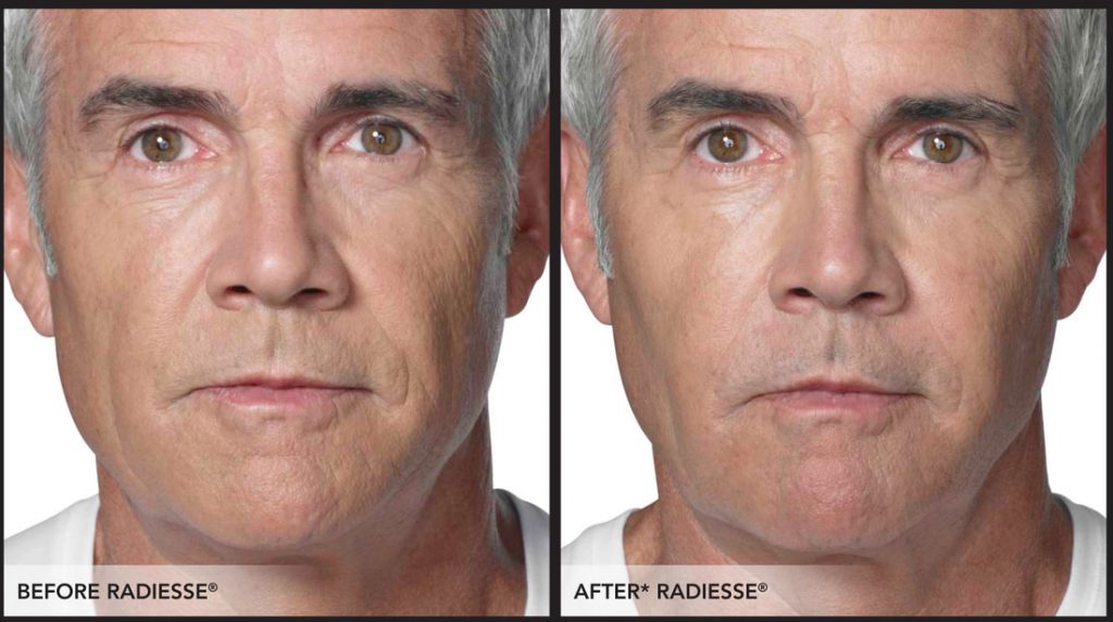 Radiesse filler for nasolabial folds, cheeks and jawline in a male by Dr. BCK Patel MD, FRCS