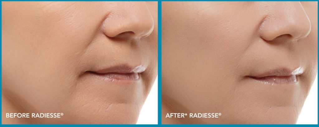 Radiesse filler for nasolabial folds, cheeks and jawline in a female by Dr. BCK Patel MD, FRCS