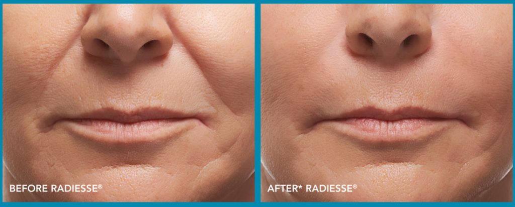 Radiesse filler for nasolabial folds, cheeks and jawline in a female by Dr. BCK Patel MD, FRCS