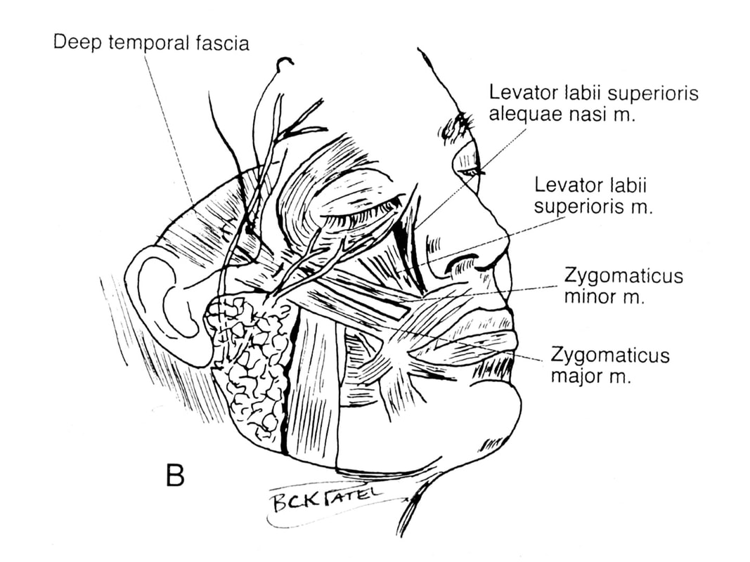 The surface anatomy of the malar eminence in a female. Anatomy underlying the malar prominence which gives beauty fo the face by Dr. BCK Patel MD, FRCS of patelplasticsurgery.com of Salt Lake City and St. George Utah Illutrates the surgical technique as designed by Dr. BCK Patel MD, FRCS