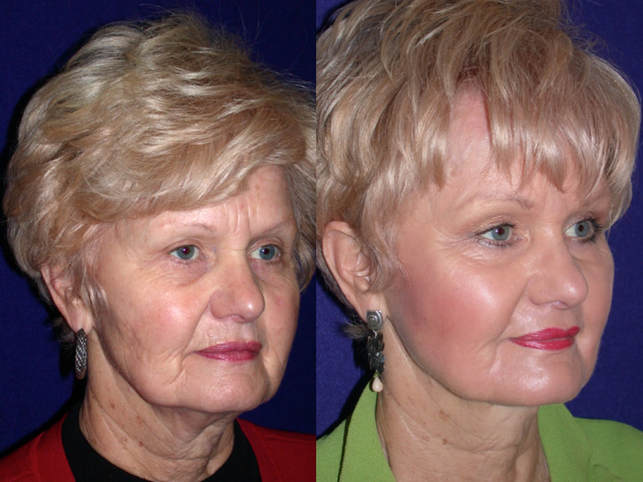 Principles of the Hammock Lift as designed by Dr. BCK Patel MD, FRCS of patelplasticsurgery.com of Salt Lake City and St. George Utah Shows results of the performance of a full Hammock Lift in a female. A split face view showing the amazing improvement in the skin and the face