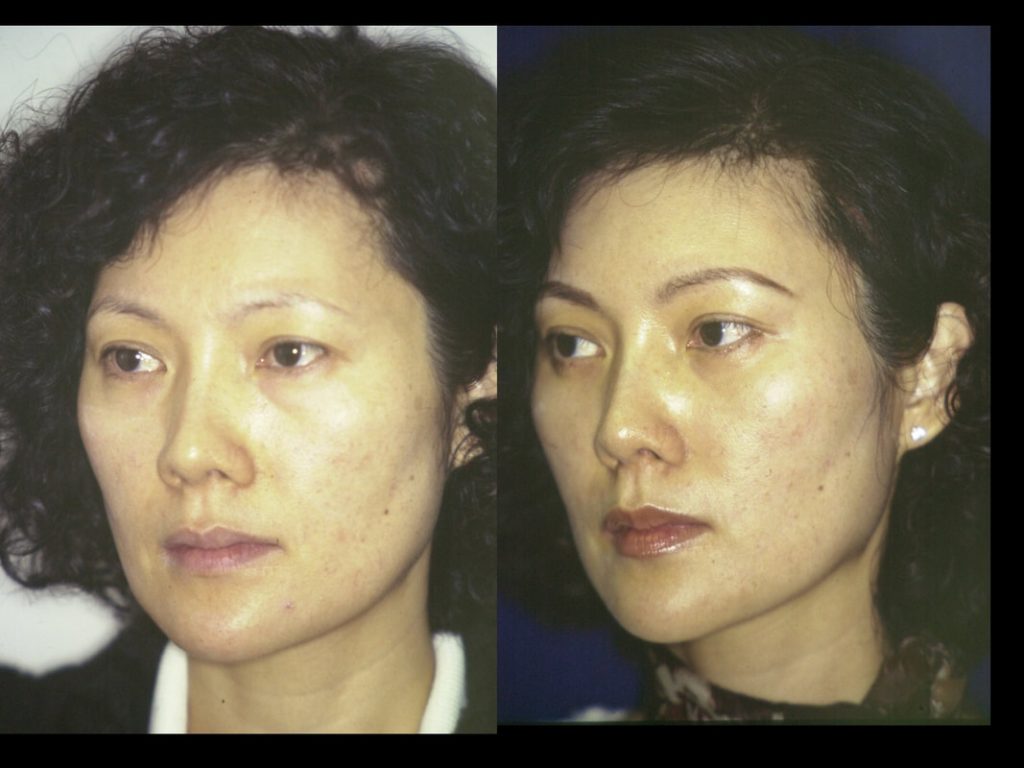 Hammock Lift in an Asian: Principles of the Hammock Lift as designed by Dr. BCK Patel MD, FRCS of patelplasticsurgery.com of Salt Lake City and St. George Utah Shows results of the performance of a full Hammock Lift in a female. A split face view showing the amazing improvement in the skin and the face