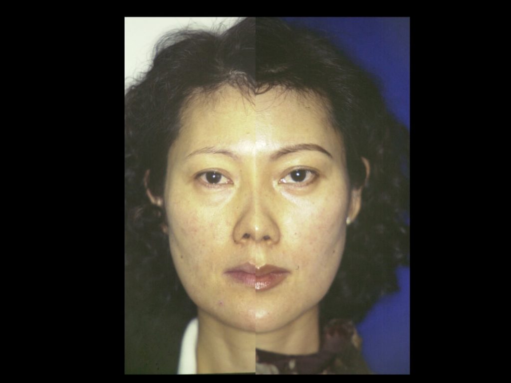 Hammock Lift in an Asian: Principles of the Hammock Lift as designed by Dr. BCK Patel MD, FRCS of patelplasticsurgery.com of Salt Lake City and St. George Utah Shows results of the performance of a full Hammock Lift in a female. A split face view showing the amazing improvement in the skin and the face
